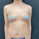 豊胸（脂肪注入） 湘南美容クリニック 吉祥寺院 AFTER サムネイル用