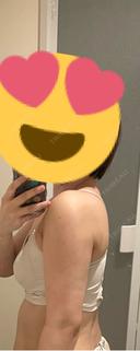 脂肪吸引（二の腕） アムルーズ美容外科クリニック 横浜院 DAY 28 サムネイル用
