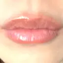 ヒアルロン酸注入（唇） アネシス美容クリニック DAY 7 サムネイル用