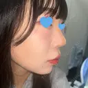 その他（目元） / 隆鼻術 / 鼻中隔延長（切開） / 軟骨移植 / 骨切幅寄せ / 眉間プロテーゼ / 自然癒着法 LUHO（ルホ）美容外科 AFTER サムネイル用