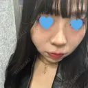 その他（目元） / 隆鼻術 / 鼻中隔延長（切開） / 軟骨移植 / 骨切幅寄せ / 眉間プロテーゼ / 自然癒着法 LUHO（ルホ）美容外科 DAY 161 サムネイル用