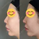 鼻尖形成（切開） / 人中短縮 / 鼻孔縁挙上 / その他（鼻） アリエル美容クリニック 大宮院 DAY 182 サムネイル用