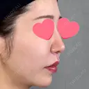 鼻尖形成（切開） / 人中短縮 / 鼻孔縁挙上 / その他（鼻） アリエル美容クリニック 大宮院 DAY 182 サムネイル用