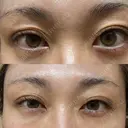 眼瞼下垂（非切開） SOL CLINIC AFTER サムネイル用