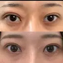 二重埋没 湘南美容クリニック 池袋東口院 DAY 7 サムネイル用