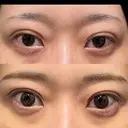 二重埋没 湘南美容クリニック 池袋東口院 DAY 8 サムネイル用