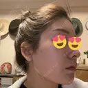 医療脱毛（顔） ジュエルクリニック 恵比寿院 DAY 2 サムネイル用