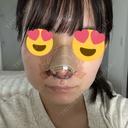 鼻尖形成（切開） / 小鼻縮小（切開） / その他（鼻） / 軟骨移植 / 毛穴洗浄（ハイドラフェイシャルなど） KARIS beauty clinic DAY 3 サムネイル用