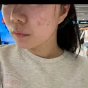 その他（肌） / ピーリング（ニキビ・毛穴） / ポテンツァ HAAB×DREAM BEAUTY CLINIC 大阪梅田院 DAY 0 サムネイル用