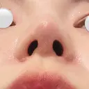 隆鼻術 / 鼻尖形成（切開） / 小鼻縮小（切開） / 軟骨移植 / 眉間プロテーゼ / 鼻修正 / 鼻尖縮小 / 鼻柱下降・鼻唇角形成（猫手術） / その他（鼻） グローバルビューティークリニック 銀座院 DAY 77 サムネイル用