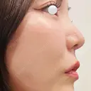隆鼻術 / 鼻尖形成（切開） / 小鼻縮小（切開） / 軟骨移植 / 眉間プロテーゼ / 鼻修正 / 鼻尖縮小 / 鼻柱下降・鼻唇角形成（猫手術） / その他（鼻） グローバルビューティークリニック 銀座院 DAY 77 サムネイル用