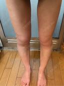 脂肪吸引（脚） / 豊胸（脂肪注入） オアシス美容外科 DAY 41 サムネイル用