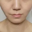 糸リフト 形成外科と美容外科のクリニック池袋 AFTER サムネイル用