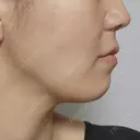 糸リフト 形成外科と美容外科のクリニック池袋 DAY 17 サムネイル用