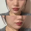 ハイフ（顔） DAILY SKIN CLINIC 福岡院 AFTER サムネイル用