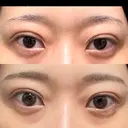 二重埋没 湘南美容クリニック 池袋東口院 DAY 9 サムネイル用