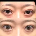 二重埋没 湘南美容クリニック 池袋東口院 DAY 10 サムネイル用