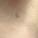 脂肪吸引（脚） / 脂肪吸引（お尻） ドクターフィット（Dr.fit）クリニック DAY 89 サムネイル用