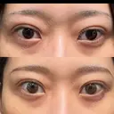 二重埋没 湘南美容クリニック 池袋東口院 DAY 11 サムネイル用