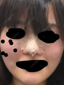 軟骨移植 三輪皮フ科形成外科 DAY 1 サムネイル用