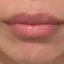 ヒアルロン酸注入（唇） アネシス美容クリニック AFTER サムネイル用