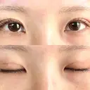 二重埋没 オアシス美容外科 DAY 5 サムネイル用