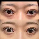 二重埋没 湘南美容クリニック 池袋東口院 DAY 12 サムネイル用