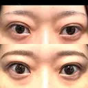 二重埋没 湘南美容クリニック 池袋東口院 DAY 13 サムネイル用