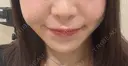 ボトックス（エラ・小顔） / ヒアルロン酸注入（鼻翼基部） KAGA CLINIC DAY 0 サムネイル用