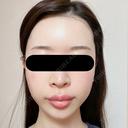 糸リフト / バッカルファット除去 / 脂肪吸引（顔） / ジョールファット除去 / ヒアルロン酸注入（額） / ヒアルロン酸注入（頬） BLINC CLINIC （ブリンク クリニック） AFTER サムネイル用