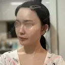 RF（高周波）たるみ治療 Chloe Cheongdam Clinic （クロエチョンダムクリニック） DAY 28 サムネイル用