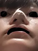 軟骨移植 三輪皮フ科形成外科 DAY 2 サムネイル用