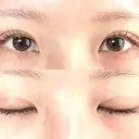 二重埋没 オアシス美容外科 DAY 6 サムネイル用