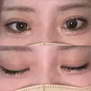 二重埋没 / 上まぶたの脂肪取り アリエル美容クリニック 横浜院 DAY 13 サムネイル用