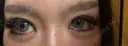 二重埋没 / 目尻切開 / 下まぶたの脂肪取り / タレ目形成・グラマラスライン（切開） / 目尻靭帯移動 エターナル美容クリニック DAY 40 サムネイル用