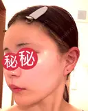 額を丸く / 脂肪注入（肌） / 脂肪注入（額） 湘南美容クリニック 柏院 DAY 22 サムネイル用