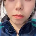 鼻尖形成（切開） / 小鼻縮小（切開） / 軟骨移植 RIVER CLINIC（リバークリニック） AFTER サムネイル用