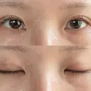 二重埋没 オアシス美容外科 DAY 7 サムネイル用