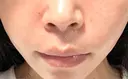 肌ヒアルロン酸注入（たるみ・シワ改善） MEMOTO CLINIC 名古屋 AFTER サムネイル用