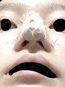 軟骨移植 三輪皮フ科形成外科 DAY 3 サムネイル用