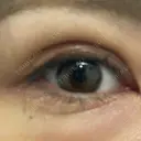 二重埋没 / 自然癒着法 Brandnew Beauty Clinic DAY 5 サムネイル用