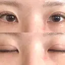 二重埋没 オアシス美容外科 DAY 8 サムネイル用