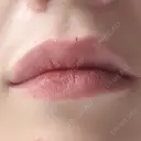 ヒアルロン酸注入（唇） Wi Clinic （ウィ クリニック）心斎橋院 DAY 0 サムネイル用