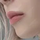 ヒアルロン酸注入（唇） Wi Clinic （ウィ クリニック）心斎橋院 DAY 0 サムネイル用