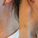 ボトックス（エラ・小顔） Natural Skin Clinic 自由ヶ丘院 AFTER サムネイル用