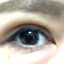 二重埋没 / 自然癒着法 Brandnew Beauty Clinic DAY 6 サムネイル用