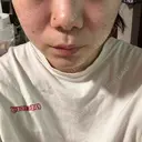 その他（肌） / ピーリング（ニキビ・毛穴） / ポテンツァ HAAB×DREAM BEAUTY CLINIC 大阪梅田院 AFTER サムネイル用