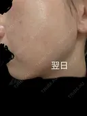 ルビーレーザー AZ BEAUTY CLINIC DAY 0 サムネイル用