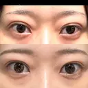 二重埋没 湘南美容クリニック 池袋東口院 DAY 14 サムネイル用