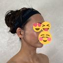 糸リフト / ピーリング（ニキビ・毛穴） / エレクトロポレーション アリエル美容クリニック 横浜院 DAY 7 サムネイル用